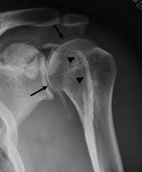 Image result for Biceps Tendon Injection