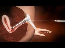 The turkey baster method is the most common way of artificial insemination to get pregnant via artificial insemination at home. 3d Animation Of How Iui Works Youtube