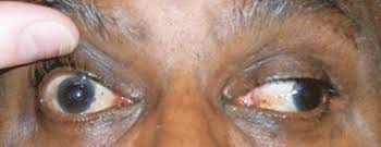 Image result for Pupillary Paralysis
