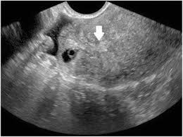 2% of all pregnancies are ectopic (very rare) and 98% of them happen in a fallopian tube. Non Tubal Ectopic Pregnancy Incidence And Diagnosis Intechopen