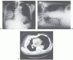 Pleural effusion is an accumulation of fluid in the pleural cavity between the lining of the lungs and the thoracic cavity (i.e., the visceral and parietal pleurae). Radiographic Examinations Thoracic Key