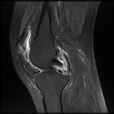 During your mri, you'll hear loud noises like thumping and tapping as the machine goes to work. Knee Synovitis Rheumatoid Arthritis Radiology Case Radiopaedia Org