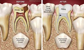 Root Canal Treatment For Children Bliley Dental