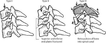 Image result for Subaxial Injury Classification Scale
