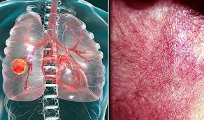 This growth can spread beyond the lung by the process of metastasis into nearby tissue or other parts of the body. Lung Cancer Symptoms Signs Of Tumour Include Itchy Skin Rash Pain Express Co Uk