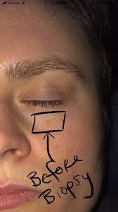 The world's most common cancer is a relentless disease that strikes one in five people by age 70. Skin Cancer Woman Discovers Basal Cell Carcinoma Near Eye