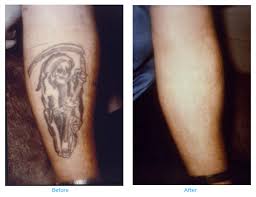 But that's not quite the answer you were wanting right? Permanently Remove Unwanted Tattoos With Laser Tattoo Removal In Nh