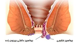 درمان انواع بیماری بواسیر یا هموروئید داخلی خارجی وخونی وعلائم آن چیست فوق تخصص گوارش و کبد دکتر رضا دوست
