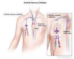A central venous catheter (katheter), also known as a central line or cvc, is long, soft, thin, hollow tube that is placed into a large vein (blood vessel). Global Central Venous Catheters Market Import Export Scenario Application Growing Trends And Forecast 2020 2025 Bcfocus
