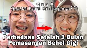 Penyimpangan ajaran ldii, hukum memakan katak, mimpi dalam islam & makna, download al ikhlas, cara memanggil khodam pendamping, sholat sunat sebelum jumat Hukum Meratakan Gigi Dan Pasang Behel Ustadz Khalid Basalamah By Velo Cayaha