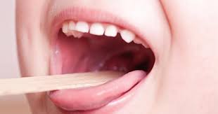Dolor De Garganta Faringitis