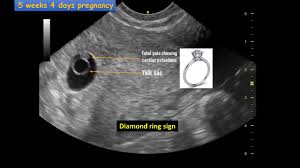 It finds its origins in late middle english: Early Pregnancy Showing Cardiac Flicker Youtube