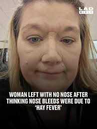 She didn't realise her whole nose would be removed during surgery.