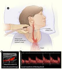 Vascular Endovascular Surgery Carotid Ultrasound
