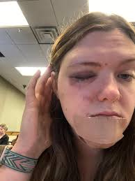 Experiences with painful plastic objects