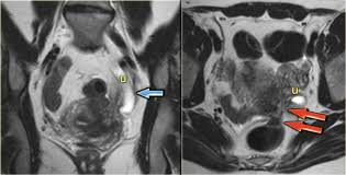 Endometriosis affects an estimated 176 million women worldwide regardless of their ethnic and many remain undiagnosed and are therefore not treated. The Radiology Assistant Endometriosis Mri Detection