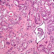 The rise in these numbers will occur well before any clinical signs or symptoms manifest themselves. Old Drug Gets New Trick For Prostate Cancer Treatment Stat
