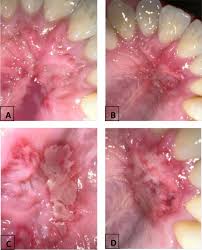 Image result for Fixed Drug Eruption