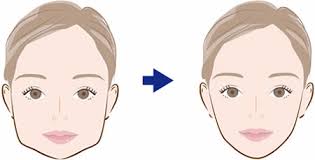 エラ骨切り術のダウンタイム・副作用・リスクについて| 池袋の美容皮膚科・美容外科なら「みずほクリニック」