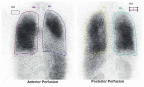 Image result for Ventilation Perfusion Scan