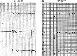 Image result for Epsilon Wave