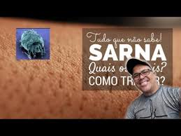 O tratamento da sarna humana ou escabiose consiste essencialmente na aplicação tópica (isto é, diretamente sobre a pele) de soluções escabicidas. Tratamento Escabiose Sarna Humana Pratico E Rapido Tratamento Escabiose Sarna Humana Youtube