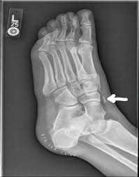 I feel only a little pain in my ankle from the. Fleck Sign Traumatic Avulsion Fracture Of The Medial Cuneiform By Anterior Tibialis Tendon