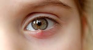 Die symptome trockener augen sind vielfältig: Woher Kommen Kleine Knotchen Am Auge Lasik Care Blog
