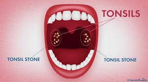In many cases, tonsil stones can be removed safely at home. Tonsil Stones Find Out How Gulf View Medical Centre Facebook