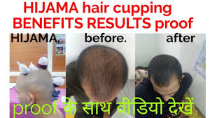 Now i have thicker, stronger hair and do not suffer any loss. Hijama Hair Cupping Benefits Results Proof à¤• à¤¸ à¤¥ à¤µ à¤¡ à¤¯ à¤¦ à¤– Youtube