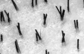 It may or may not be accompanied by an infection of the hair follicle (folliculitis) or razor bumps (pseudofolliculitis barbae), which vary in size. Multiple Two Hairs One Follicle On Scalp Armpit Pubic Area Get Rid Hair Mag