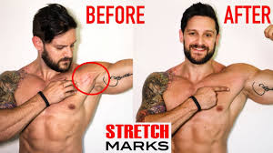 As time goes by, stretch marks do natural fade to a few shades lighter than your natural skin tone. Stretch Mark Removal Best Medical To Home Remedies Why You Shouldn T Be Ashamed Lex Fitness Youtube
