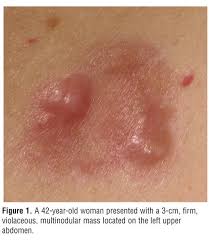 Image result for Dermatofibrosarcoma Protuberans