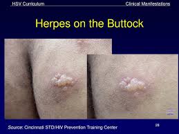 Has anyone cured herpes, herpes recovery, lysine herpes prevention, herpes best treatment, what do herpes look like in women, are all cold sores caused by secret cures for herpes antiviral creams for herpes, herpes vs razor bumps, gen herpes pictures, herpes scars on buttocks, hsv 2 lgg. Ppt Genital And Perirectal Herpes Simplex Virus Infection Powerpoint Presentation Id 2356146