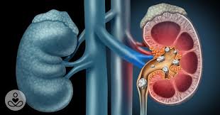 10 Habits That Can Seriously Damage Your Kidneys Kidney Health Kidney Detox Kidney Stones