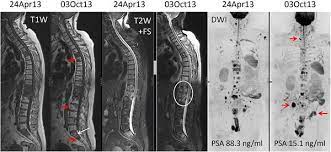 Prostate cancer is one of the most common types of cancer diagnosed in men. A 64 Year Old Man With Metastatic Castrate Resistant Prostate Cancer Download Scientific Diagram