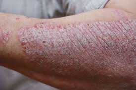 Image result for psoriasis
