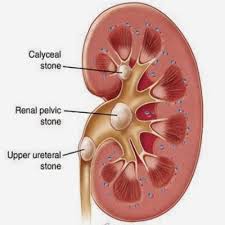 Kidney Stones Diagram Kidney Stones Symptoms Kidney Biopsy Kidney Stones Remedy