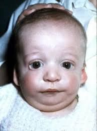 Поиск мутаций в гене tcof1, м. Mandibulofacial Dysostosis Treacher Collins Syndrome Background Epidemiology
