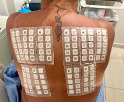 Image result for Patch Testing