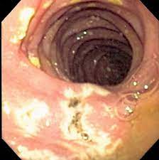 Zollinger Ellison Syndrome Wikipedia