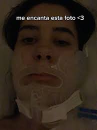 Mordida Desviada Antes Y Despues