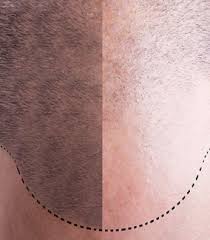 Pay qr99 instead of qr200. Vlcc Weight Loss Laser Hair Removal Beauty Packages