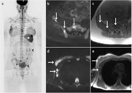Lobular breast cancer can be more difficult to see on imaging and scans. Whole Body Mri For Systemic Staging Of Breast Cancer In Pregnant Women The Breast