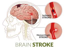 Saya juga mengalami stroke ringan bagian tubuh sebalah kanan karena pernah terjatuh sebanyak 3 kali. Mengobati Stroke Sebelah Kanan Obat Bronkopneumonia
