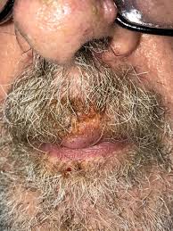 Image result for Impetigo