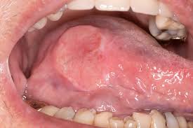 Image result for dental cancer