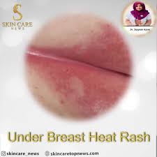 Image result for heat rash under breasts