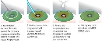Lasik is the acronym for laser in situ keratomileusis. Tulsa S Most Trusted Lasik Surgeon And The Tlc Lifetime Commitment