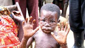 Between 1970 and 1986, over 400 cases in humans were reported. Monkeypox And Memories Of Ebola Virus Disease The Guardian Nigeria News Nigeria And World News Features The Guardian Nigeria News Nigeria And World News